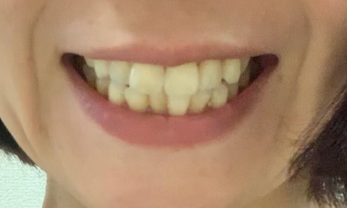 ホワイトニング前の歯の様子