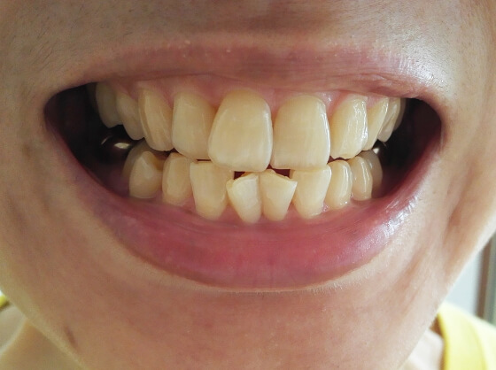 ホワイトニング前の歯の様子